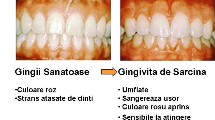 gingivita-de-sarcina1