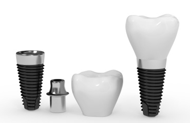 implant dentar ami dent ploiesti